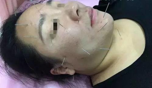 面瘫艾灸视频,轻松缓解面部不适,恢复微笑